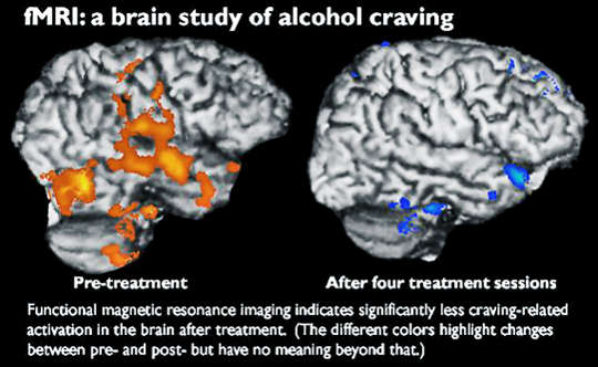 Brain Scans Suggest This Therapy Will Ease Alcohol Cravings